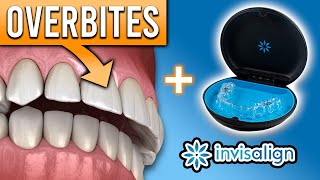 Can Invisalign FIX Overbites amp Other Bite Problems  Premier Orthodontics [upl. by Rimahs340]