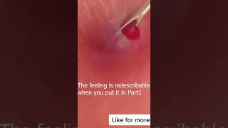 pimple popping 2022 new blackheads on noseacne treatment at home for oily skinshortscrazyacne [upl. by Morley]