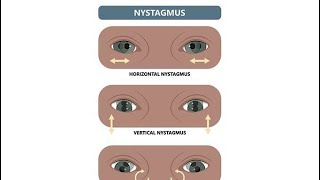 Nystagmus spontaneous Eye movement disorders and Saccadic intrusion Causes and possible treatment [upl. by Silvers]