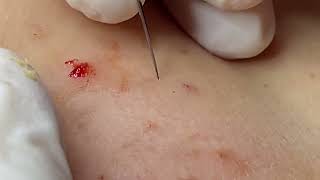 Make your Acne Treatment Dr Thuy Truong 437  acne 2023 [upl. by Kathlin]