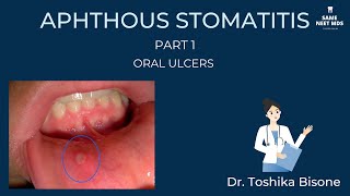 Aphthous stomatitis  Part 1  Oral ulcers [upl. by Akiemat]