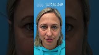 Eyelid Surgery The Healing Process [upl. by Teeter]