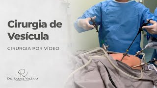 Cirurgia Real de Vesícula por Vídeo [upl. by Firehs]