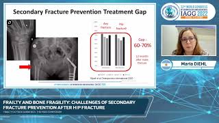 37Frailty outside geriatrics the frog symposium [upl. by Annaehr396]