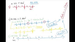 EKG 5 by Coiled CZECH AV bloky Mobitz Wenckebach blok levého LBBB a pravého Tawarova raménka [upl. by Ddarb862]