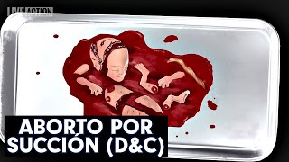 Aborto del 1er Trimestre  Dilatación y Legrado por Succión DampC [upl. by Aikkan]