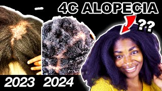 I ignored my 4C natural hair for a YEAR Heres what happened Alopecia Journey [upl. by Jump]