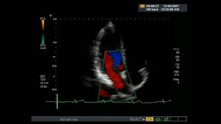 Echocardiogram  Heart ultrasound [upl. by Archibold]