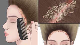 ASMR Animation  Satisfying Scalp Treatment  Big Flakes Dandruff Removal  Meng’s Stop Motion [upl. by Derina221]