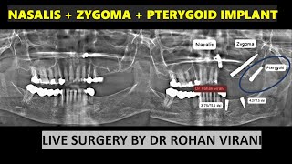 NASALIS  ZYGOMA  PTERYGOID IMPLANT  LIVE SURGERY BY DR ROHAN VIRANI [upl. by Sevein]