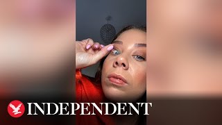 Woman shares clip of her popping a spot under her eyelid [upl. by Ayikur]