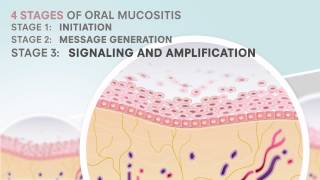 Oral Mucositis and Gelcair [upl. by Ynohta229]