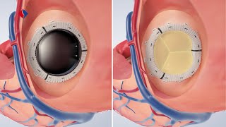 Mitralklappeninsuffizienz OP  Medizinische Animation [upl. by Marieann920]