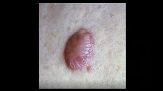 What are keloid scars and how to treat them [upl. by Schmidt820]