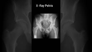 x ray Pelvis Apophyseal avulsion fracture of the left iliac crest is present shoets [upl. by Paymar]