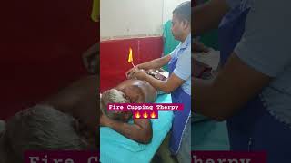 Fire Cupping Therpy muscles relif pain viralvideo youtubeshorts ayurveda firecupping [upl. by Roze]