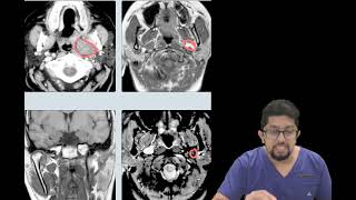 Pleomorphic Adenoma of parapharyngeal space PPS [upl. by Siraj]