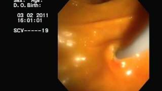 CPRE y drenaje de Colangitis Aguda ERCP acute cholangitis [upl. by Sternick]