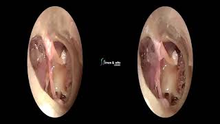 3D Endoscopic Ear Surgery Dissection Demonstration [upl. by Adkins]