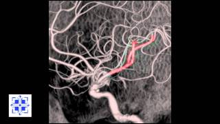 Interventional Stroke Rounds  Stroke Reversal with Penumbra [upl. by Otreblig667]