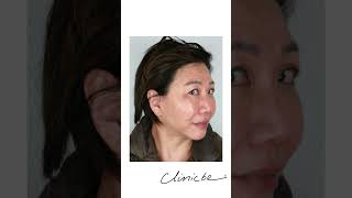 Combination Treatment  Aqualyx pdothreads and Meline  Clinicbe beauty aesthetics skin [upl. by Welch]