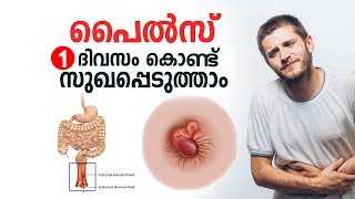 പൈൽസ് ഒരു ദിവസം കൊണ്ട് സുഖപ്പെടുത്താം  Piles Malayalam Health Tips [upl. by Anirehc274]