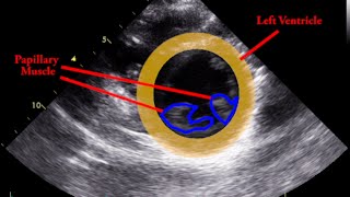 Papillary Muscle  Parasternal Short Axis [upl. by Etnoed460]