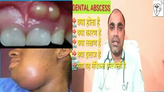 दॉतों में पस से कैसे पायें छुटकारा  Dental Abscess treatment  Dental Abscess types  Dental Absces [upl. by Bonilla]