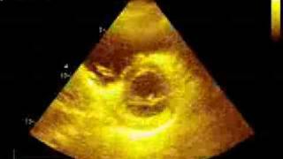 Pulmonary embolism echocardiography [upl. by Costin793]