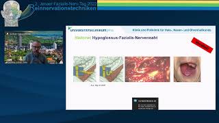 Präsentation der OPTechnik HFJA HypoglossusFazialisJumpAnastomose von Prof O GuntinasLichius [upl. by Macmillan813]