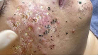 Big Cystic Acne Blackheads Extraction Blackheads amp Milia Whiteheads Removal Pimple Popping  9021 [upl. by Nievelt]