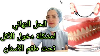 الحل النهائي لمشكلة دخول الأكل تحت طقم الأسنان المتحرك الكامل أو الجزئي Prothèse dentaire amovible [upl. by Rizzo]