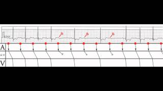 Kardioblog  AV bloky 21 high grade Mobitz I vagotonní [upl. by Osrick]
