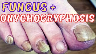 Thick fungal toenails treatment  Rams Horn onychogryphosis [upl. by Hussey]