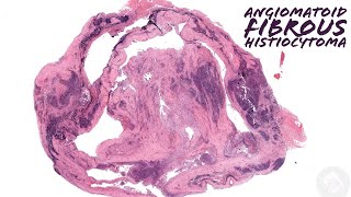 Angiomatoid fibrous histiocytoma Australasian Dermpath 2022  Case 7 pathology dermatology [upl. by Janette954]