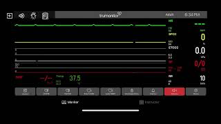 Primary Ventricular Standstill P wave Asystole [upl. by Llecrup189]