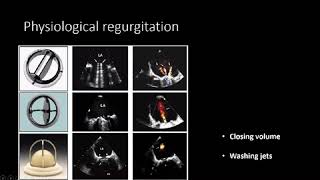 ECHO evaluation of Prosthetic Valves MITRAL PHILIPS Webinar [upl. by Inavoy]