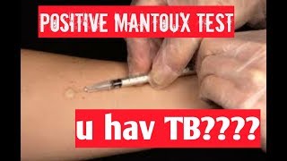 positive mantoux test tuberculin test positive result means [upl. by Persons]