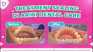 Proses Scaling Gigi di Arini Dental Care [upl. by Curcio]