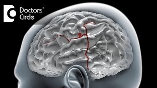 Can a ruptured Brain Aneurysm cause violent or aggressive behavior  Dr Tejus MN Rao [upl. by Chema]