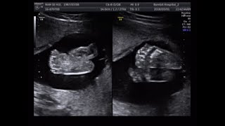 fetal ultrasound of 20 weeks 21 weeks baby boy moving [upl. by Josias]