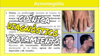 ⚕️🩺 Acromegalia y Gigantismo HIPERSECRECIÓN DE HORMONA DEL CRECIMIENTO Síntomas y Tratamiento [upl. by Owens]