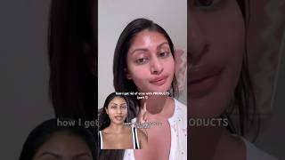 How I Get Rid Of Acne With Products Part 1 [upl. by Suzy]