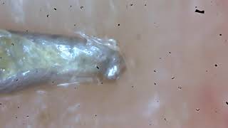 Demodex Facemite removal [upl. by Aldwin]