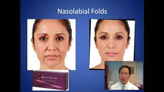 Whats the Best Filler for Smile Lines  Nasolabial Folds Consultation  Dr Anthony Youn [upl. by Libbie190]