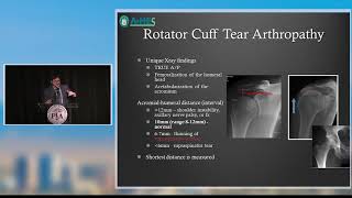 PAOS Pearl Rotator Cuff Arthropathy [upl. by Felske]