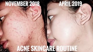 How I Cleared my Acne amp Pimples in 1 Month using Kojie San Soap amp Eskinol  DalacinC 🙈🤍🧖🏻‍♀️ [upl. by Aeki]