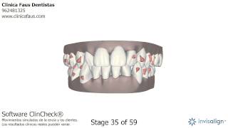 Clase III tratada con ortodoncia invisible Invisalign [upl. by Nospmas]