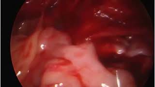 Laparoscopic Pyeloplasty in a 2 year old child [upl. by Nebuer]