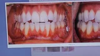 Gum Recession amp Orthodontics Theyre Connected [upl. by Gipsy]